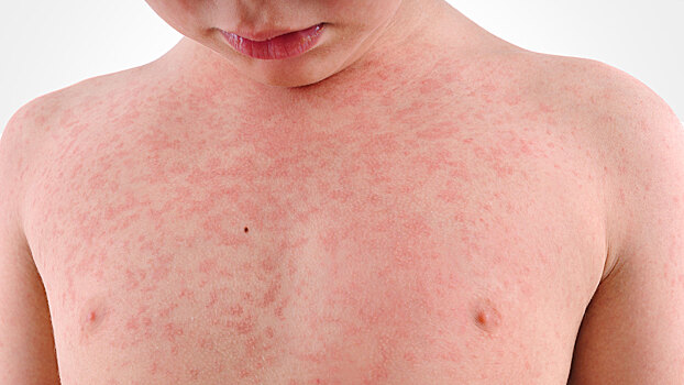 Сыпь у ребёнка: учимся отличать потницу от аллергии