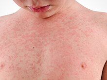 Сыпь у ребёнка: учимся отличать потницу от аллергии