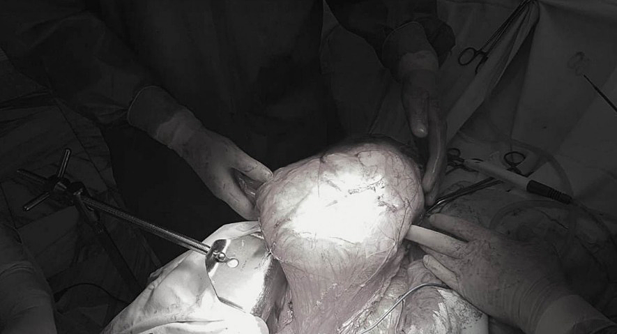 Красноярцу вырезали 6-килограммовую опухоль