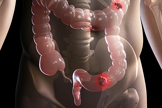 Врачи назвали опасность частых запоров и вздутия живота