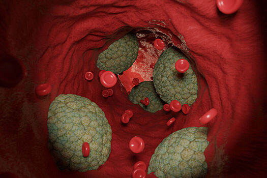 Как скрытые болезни сосудов влияют на риск деменции
