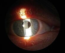 В кировской офтальмологической больнице проведена первая операция по имплантации искусственной радужки глаза