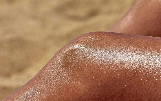 Врач назвала солнечную крапивницу одним из проявлений аллергии на солнце