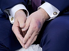 Трамп раскрыл тайну своего синяка на руке, речь идет об аспирине