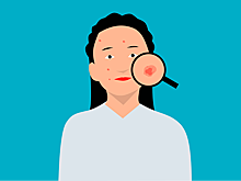 Эпидемиолог НИИ Роспотребнадзора раскрыла самые частые кожные проявления "омикрона"