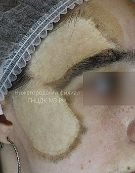 Молодой нижегородке успешно пересадили кожу лица