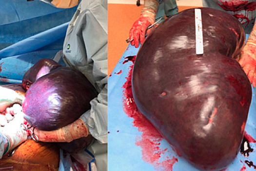 Врачи удалили мужчине самую большую селезенку в истории