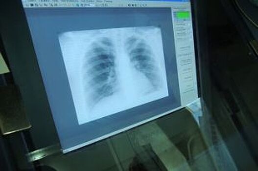 В Псковской области снизились заболеваемость и смертность от туберкулеза