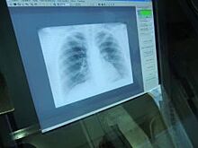 В Псковской области снизились заболеваемость и смертность от туберкулеза