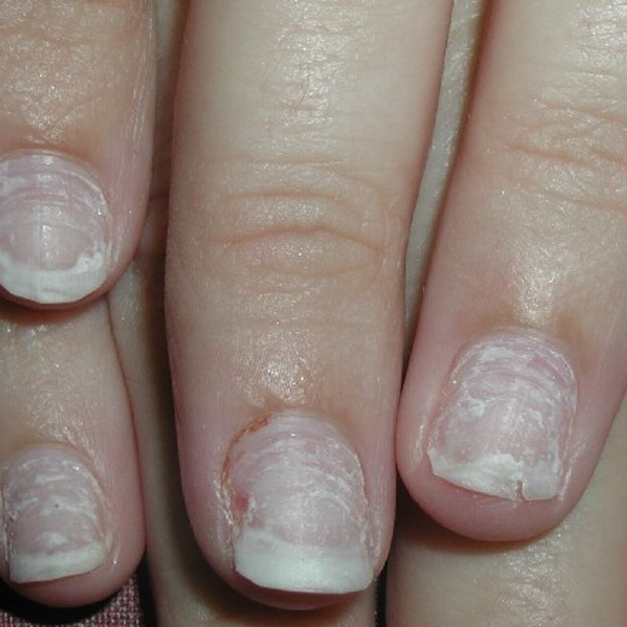 Ногти после аппаратного маникюра. Синегнойная палочка на ногтях. Псориатическая паронихия. Синегнойная палочка (Псевдомония); 2). Ногти после снятия нарощенных ногтей.