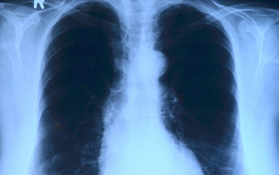 Как «убитый» туберкулез вновь обретает силу