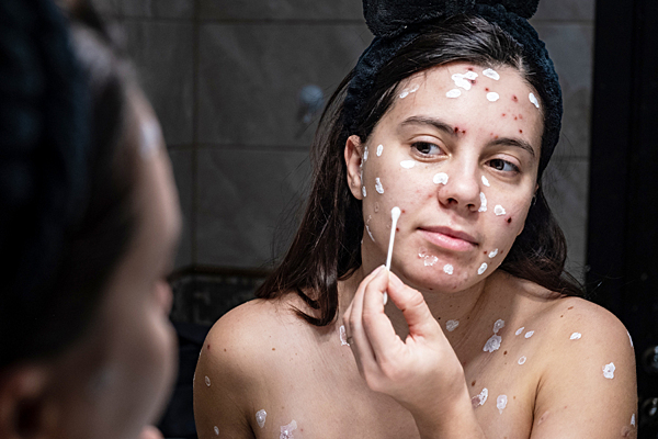 Чем опасна ветрянка