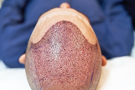 В Турции британский турист умер после пятичасовой операции по пересадке волос