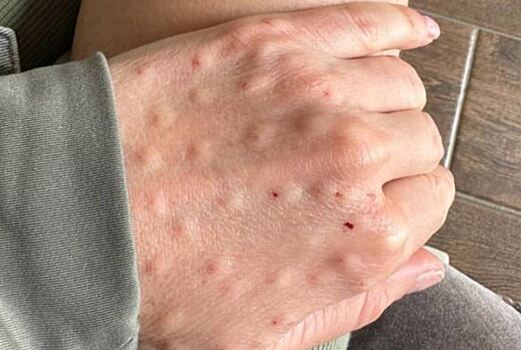 Пынзарь показала пугающие последствия косметологической процедуры