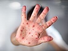 На Ямале зарегистрировано 13 подтверждённых случаев вируса кори