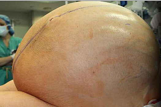 Врачи удалили женщине 60-килограммовую опухоль яичника