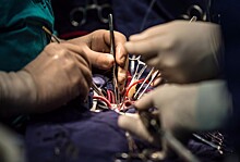 В Индии была проведена успешная бескровная операция на открытом сердце