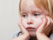 Число заболевших корью в Крыму за неделю выросло почти на треть
