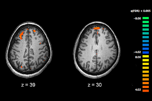Ученые: пациенты с шизофренией чаще умирают от COVID-19
