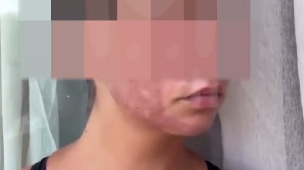 Девушка из Краснодара получила серьезные ожоги после сеанса фототерапии