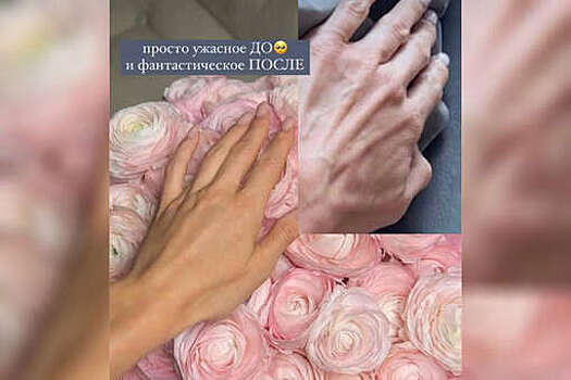 Модель Лена Перминова опубликовала фото рук после инъекций филлерами
