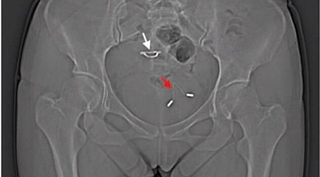 У молодой мамы в мочевом пузыре нашли внутриматочную спираль