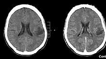 Суицидальные наклонности связали с увеличением опухоли мозга