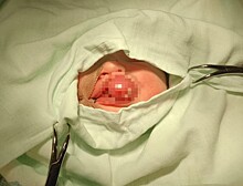 Благовещенские хирурги провели уникальную операцию новорождённому ребёнку с редкой патологией