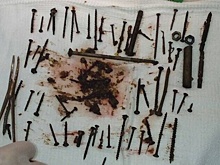 Бурятская пенсионерка питалась гвоздями и шурупами