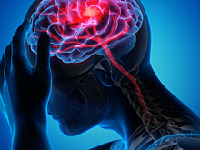 День борьбы с инсультом: ежегодно умирают 6,5 млн человек