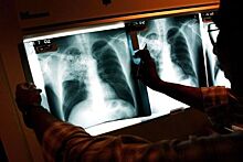Назван самый подверженный туберкулезу регион России