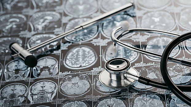 Обнаружена новая вероятная причина неизлечимой деменции