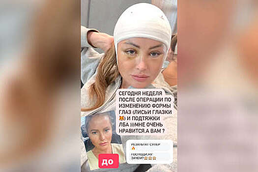 Телеведущая Дана Борисова показала лицо через неделю после блефаропластики