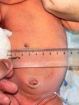 В России младенец родился с пулей в животе