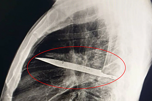 В Танзании врачи спасли мужчину, который прожил восемь лет с ножом в груди