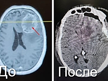 Сильная боль и тошнота оказались симптомами крупной опухоли мозга у кузбассовца