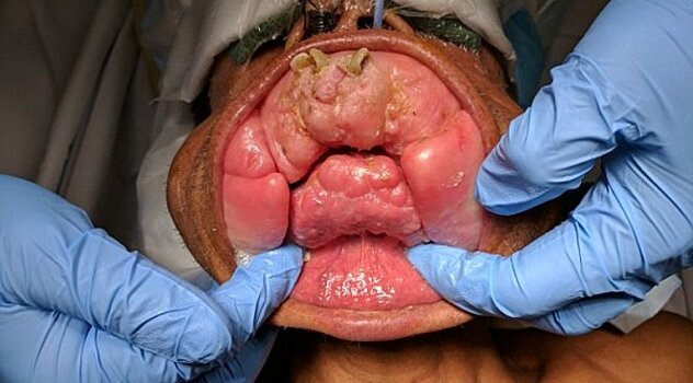 Пластический хирург вернул мужчине нормальный рот