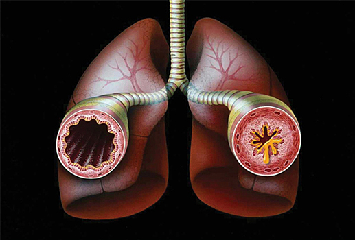 Ученые работают над лечением тяжелой формы астмы