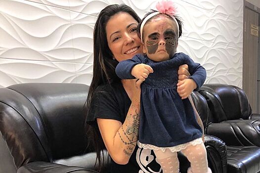 Девочка-«Бэтмен» бойко скачет на кровати спустя два дня после операции по пересадке кожи