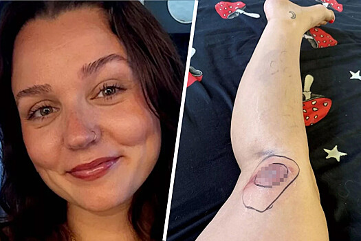 Американка едва не лишилась ноги после укуса паука