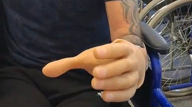 Участнику СВО из Пензенской области установили протезы рук и ног