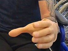 Участнику СВО из Пензенской области установили протезы рук и ног