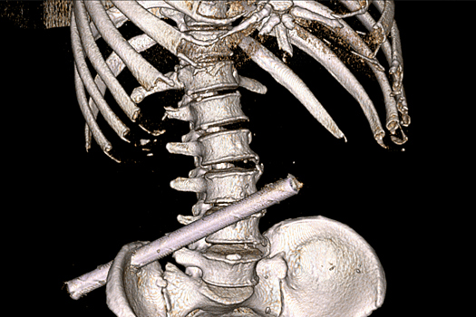 "Выпил, упал": из тела россиянина извлекли 25-сантиметровую трубу