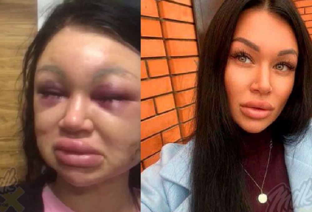 «Девушка в больнице»: в Таганроге мужчина жестоко избил свою возлюбленную