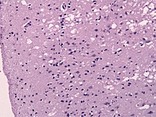 Впервые выявлены случаи заражения болезнью Альцгеймера