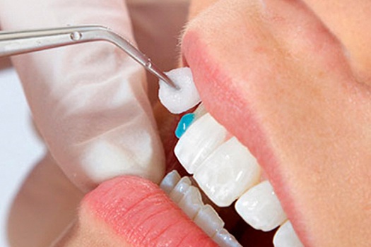Как сейчас лечат клиновидные дефекты зубов?
