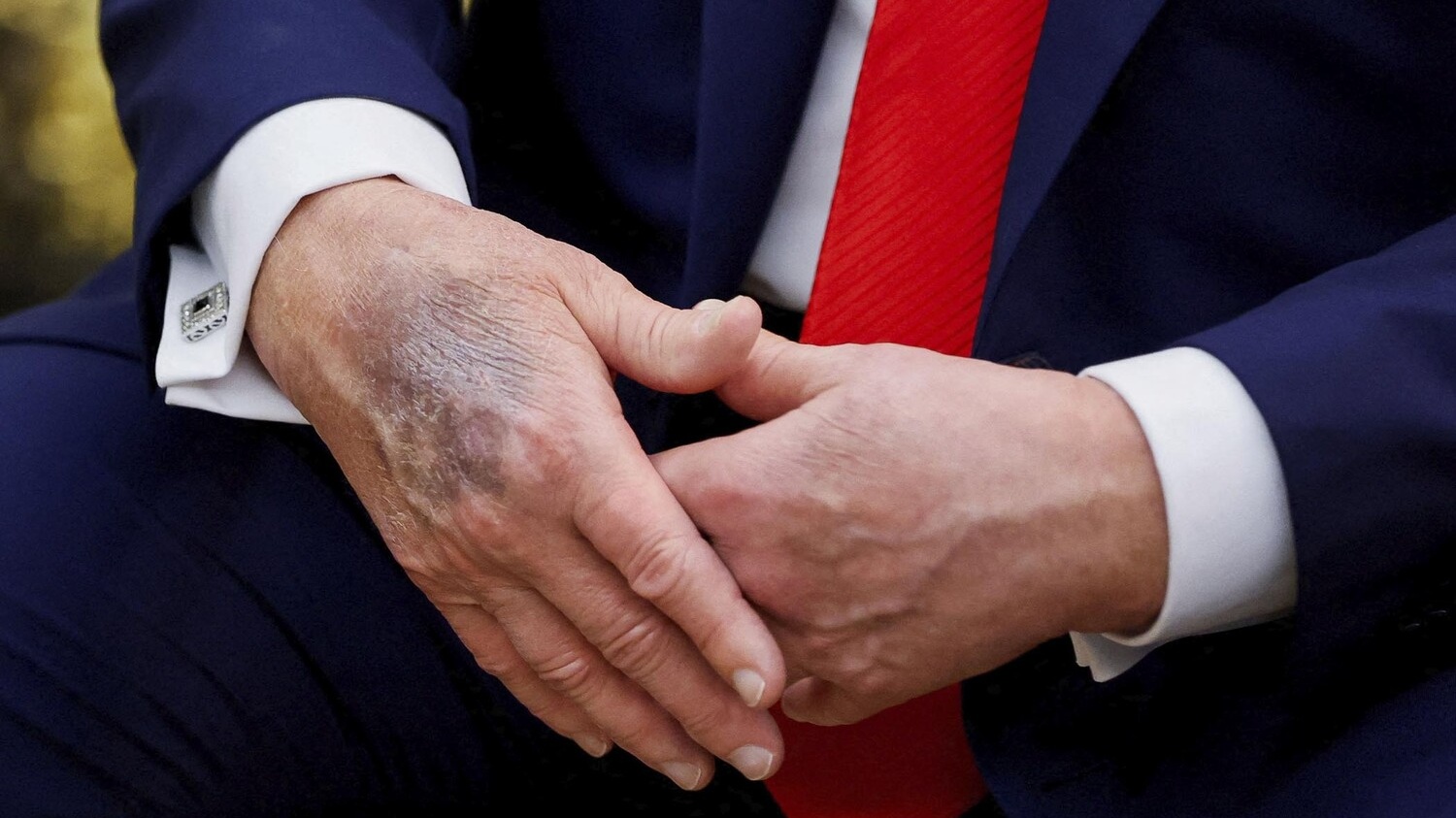 На руке Трампа увидели новый огромный синяк