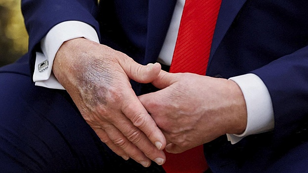 На руке Трампа увидели новый огромный синяк