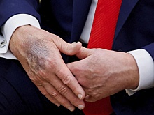 На руке Трампа увидели новый огромный синяк