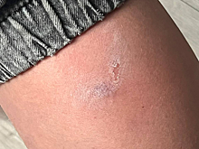 В Кузбассе бродячие собаки продолжают кусать детей